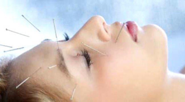 Akupunktur İle Migren Tedavisi