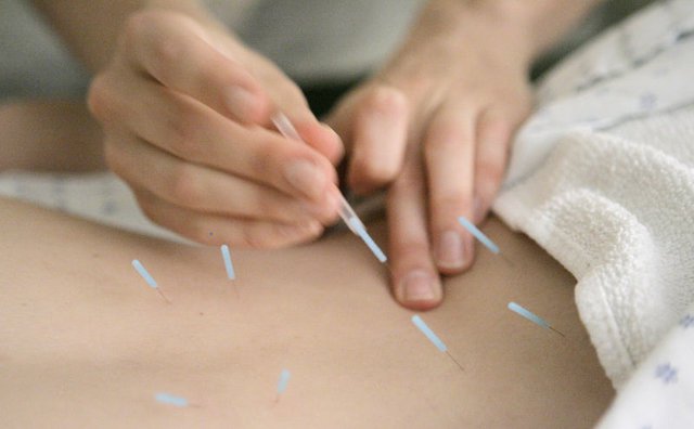 Akupunktur İle Bel Fıtığı Tedavisi