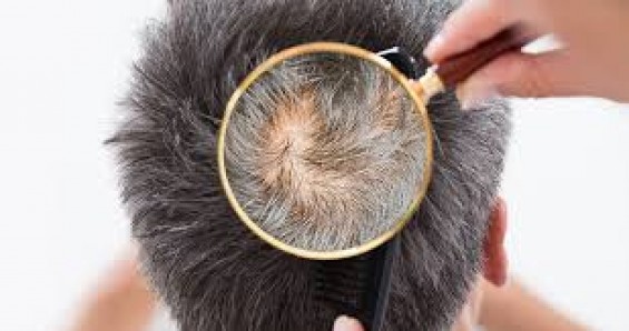 Saç Analizi Nedir? Nasıl Yapılır?